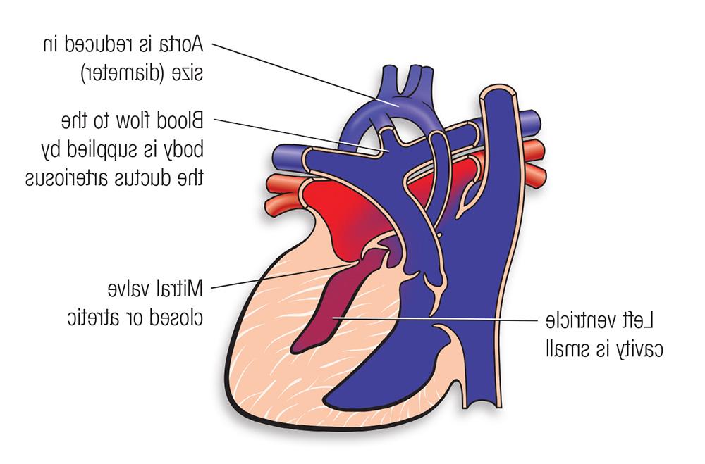 HLHS diagram